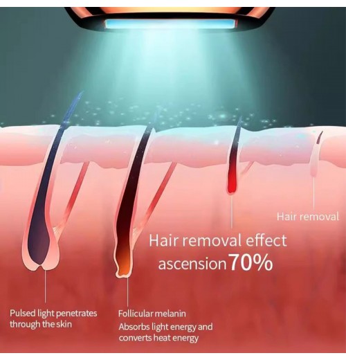 IPL-Laser-Haarentfernung